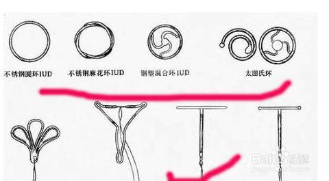 前沿科技引领，全新一代避孕神器——革命性新型节育环震撼登场