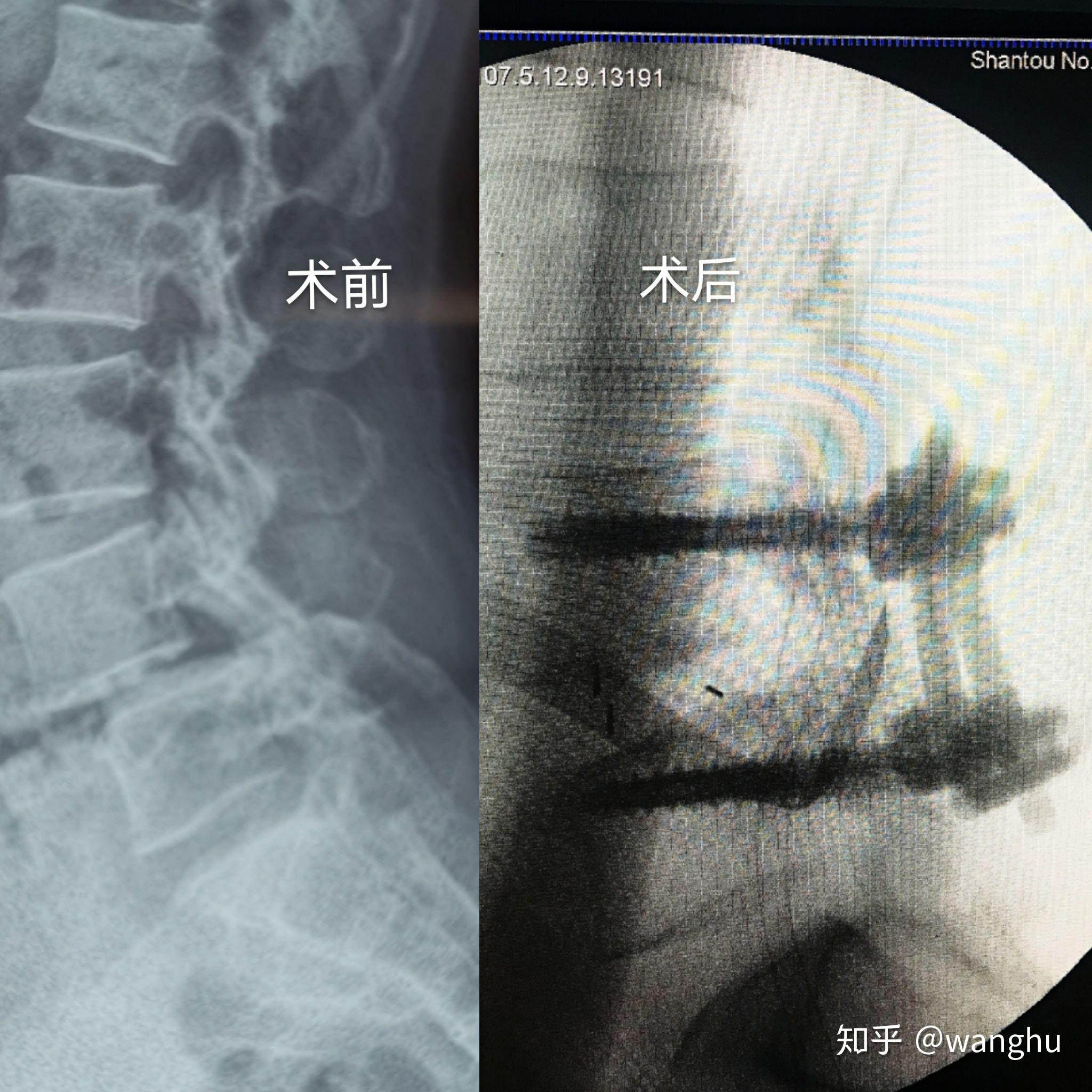 探索前沿：脊柱裂治疗的最新突破与革新方案